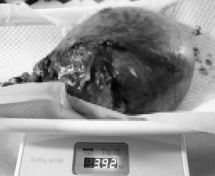 Phẫu thuật thành công cho bệnh nhân có khối u xơ tử cung nặng tới 4kg