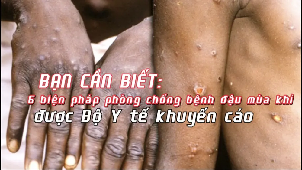 Bạn cần biết: 6 biện pháp phòng chống bệnh đậu mùa khỉ được Bộ Y tế khuyến cáo