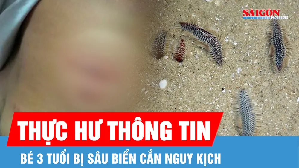 Thực hư thông tin bé 3 tuổi bị sâu biển cắn nguy kịch