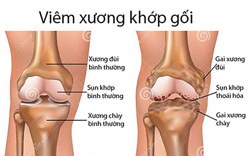 Từ biệt đau đớn do bệnh xương khớp | BÁO SÀI GÒN GIẢI PHÓNG