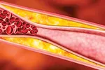 Những nguy cơ gây bệnh động mạch vành