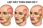 Đừng chủ quan bệnh liệt dây thần kinh VII ngoại biên