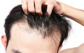新研究指出,空氣污染可能導致禿頭。(示意圖源:互聯網)
