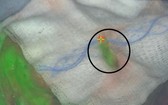 ICG 染劑使狗胸部癌細胞發出綠色螢光,同時也發現癌細胞已擴散到淋巴結(黑色圓圈處)。(圖源:Penn Vet)