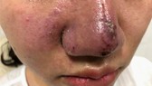 Nhiều trường hợp biến chứng do tiêm chất làm đầy