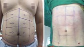 Tạo hình cơ thể - không đơn giản là phẫu thuật giảm mỡ