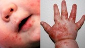 Trẻ bị tay chân miệng do virus EV71 gây ra có nguy cơ bị viêm não