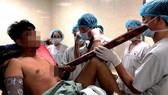 Nạn nhân bị ống sắt đâm thấu ngực