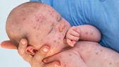 E ngại tiêm vaccine, dịch sởi bùng phát dữ dội