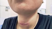 Nhiễm trùng loét cổ vì hơ nhang, đắp lá chữa bệnh basedow