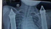 Cứu cháu bé bị thanh sắt hàng rào đâm thấu ngực