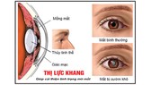 Các bệnh về mắt