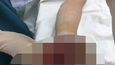Bàn tay của V. bị dập nát khi điện thoại phát nổ khi vừa sạc, vừa sử dụng