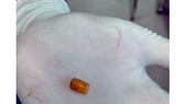 Vật thể lạ bằng nhựa cứng gây bít lòng phế quản, xẹp nửa phổi phải bé trai