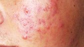 Mất tiền, mang tật vì sử dụng tế bào gốc làm đẹp