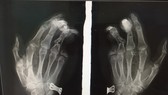 Điện thoại phát nổ khi đang sạc khiến nam thanh niên bị dập nát bàn tay
