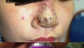 Kinh hoàng mũi bị hoại tử sau tiêm filler nâng mũi