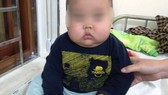 Uống thuốc có Corticoid, bé trai 17 tháng tuổi tăng 3 kg nhưng bị suy thận cấp!