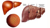 Gần 90% bệnh nhân ung thư gan bị mắc viêm gan B và C