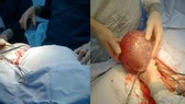 Khối u trước và sau khi mổ của bệnh nhân Nguyễn Thị Ng. - Ảnh: VTCNEWS.