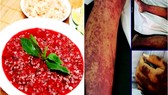 Thêm trường hợp viêm màng não do liên cầu khuẩn heo