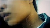 Chị Tr. với vết thương trên người. Ảnh: C.T.