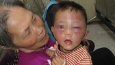 Cháu H. được đưa đến phòng khám bệnh trong tình trạng mặt thâm tím, hai mắt sưng vù... Ảnh: H.H