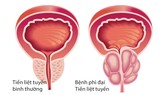 Tìm ra lối thoát mới cho bệnh phì đại tiền liệt tuyến