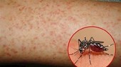 75% trường hợp tử vong do sốt xuất huyết là người lớn