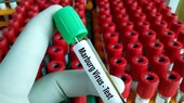Ngành y tế TPHCM khuyến cáo người dân cảnh giác với virus Marburg