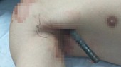 Phẫu thuật cứu thanh niên bị 2 thanh sắt đâm xuyên qua người