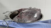 Cắt khối u hơn 8kg trong buồng trứng sản phụ