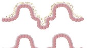 Vi khuẩn đường ruột có thể góp phần gây bệnh tiểu đường