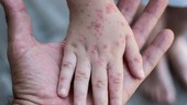 Người châu Âu vượt biên để tiêm chủng đậu mùa khỉ
