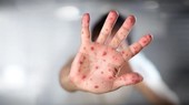 WHO đổi tên tiếng Anh cho bệnh đậu mùa khỉ