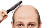 Phát hiện mới về gene gây hói