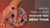 Những triệu chứng nhận biết mắc bệnh than
