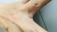Vietnam’s first monkeypox patient completely cured
