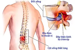 Nguyên nhân gây đau lưng, thoát vị đĩa đệm