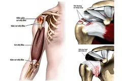 Các tổn thương thường thấy ở khớp vai: Viêm gân cơ nhị đầu; viêm hoặc rách cơ chóp xoay; viêm bao hoạt dịch khớp vai (thường co thắt gây cứng khớp vai).