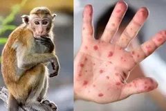 Long An xuất hiện ca đậu mùa khỉ đầu tiên
