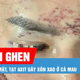 Podcast bản tin tối 8-5: Khởi tố vụ đánh ghen xăm lên mặt, tạt axit gây xôn xao ở Cà Mau