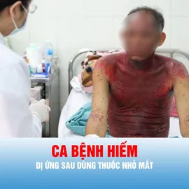 Podcast tin thời sự ngày 14-8: Thuốc nhỏ mắt có thể gây phản ứng dị ứng toàn thân