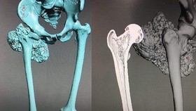 Vietnamese surgeons use 3D printing to make replacement bones