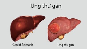 Liver cancer kills about 25,000 people yearly in Vietnam