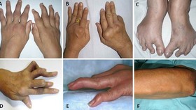 Number of Vietnamese rheumatoid arthritis patients escalating