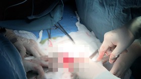Thêm một phụ nữ ngưng tim, ngưng thở do làm đẹp