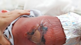 Vùng lưng của bệnh nhi nổi bóng nước, da phập phều, vùng trung tâm bị hoại tử