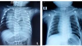 Phim chụp Xquang trước phẫu thuật của bệnh nhi phổi bên trái có nhiều dịch trắng xóa và phim chụp Xquang sau phẫu thuật