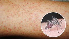 Đồng Nai: Dịch sốt xuất huyết diễn biến phức tạp